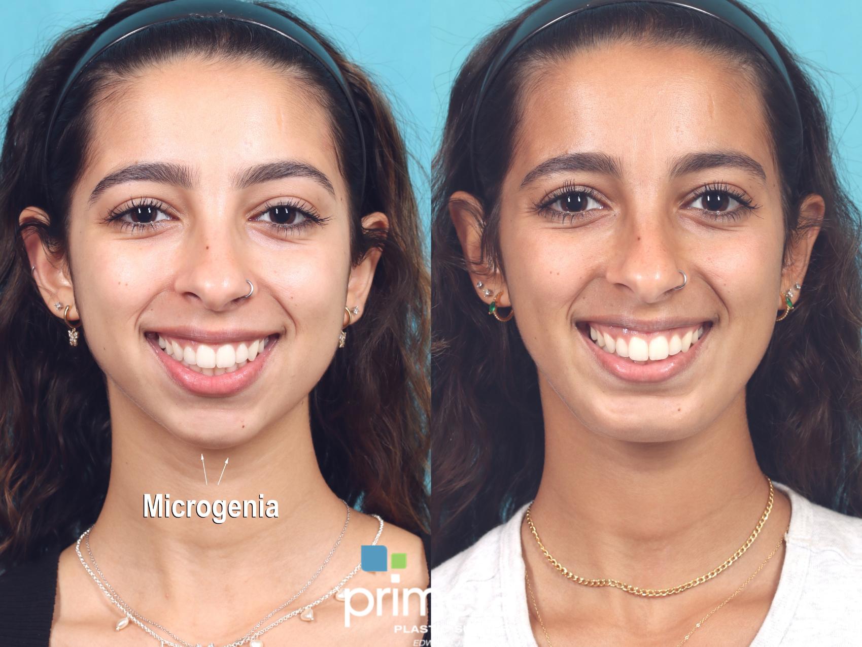 Before & After Chin & Cheek Implant Case 914 Front View in Orlando, Florida