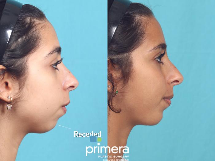 Before & After Chin & Cheek Implant Case 914 Right Side View in Orlando, Florida