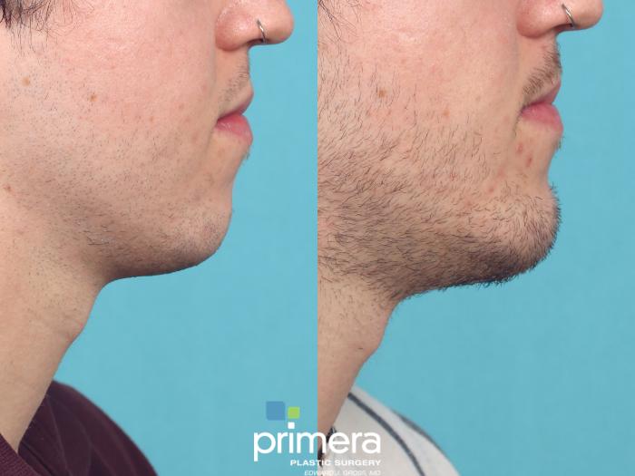 Before & After Chin & Cheek Implant Case 925 Right Side View in Orlando, Florida