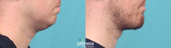 Before & After Surgery for Men Case 999 Right Side Close-Up View in Orlando, Winter Park & Tampa, Florida