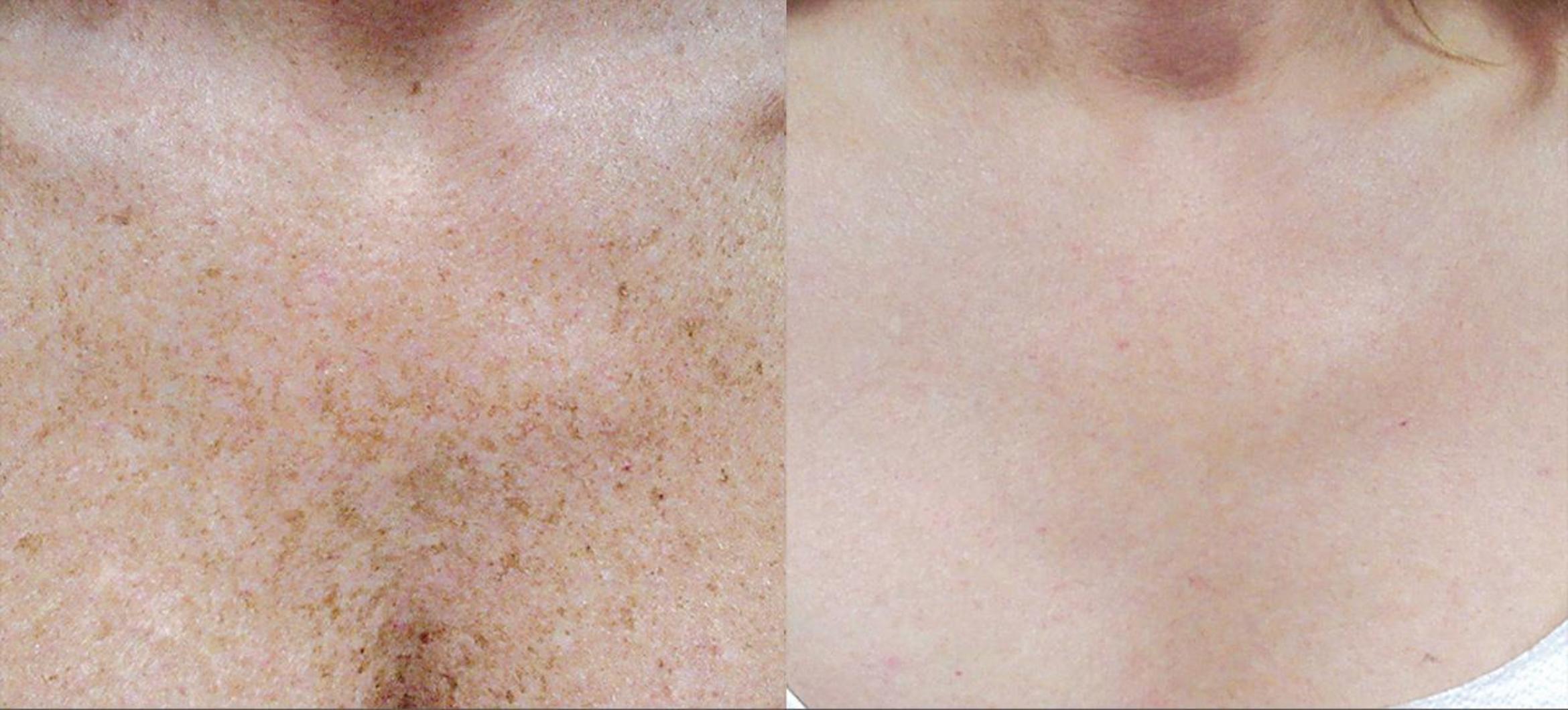 Cynosure Icon Ipl Before After Photo Gallery Orlando Florida Primera Plastic Surgery