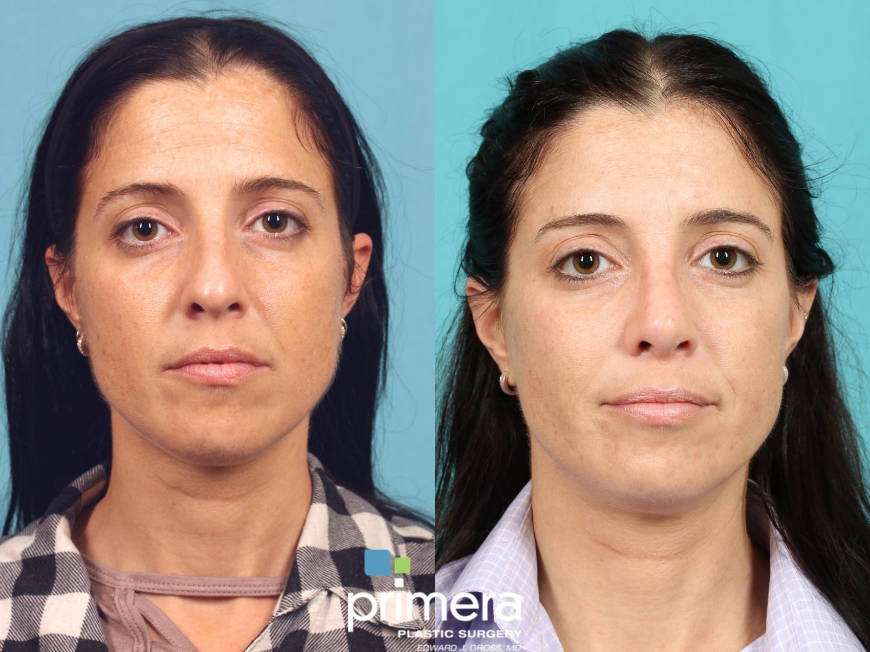 Brown Spot and Melasma Removal | Orlando, FL