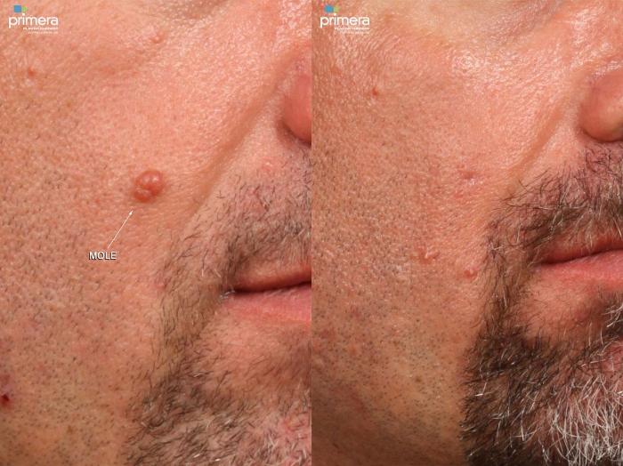 Before & After Cyst Removal Case 426 view-1 View in Orlando, Florida