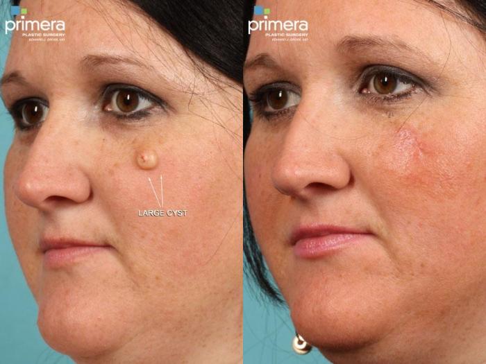 Before & After Pulsed Dye Laser (Candela V-Beam) Case 468 view-1 View in Orlando, Florida