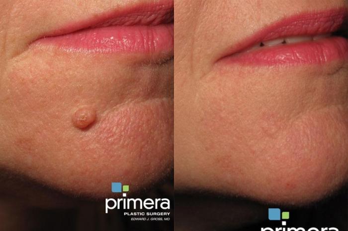 Before & After Laser Skin Resurfacing (DOT CO2) Case 498 view-1 View in Orlando, Florida