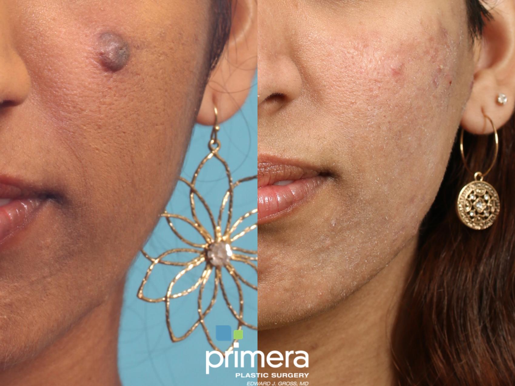 Before & After Microneedling Case 651 Front View in Orlando, Florida