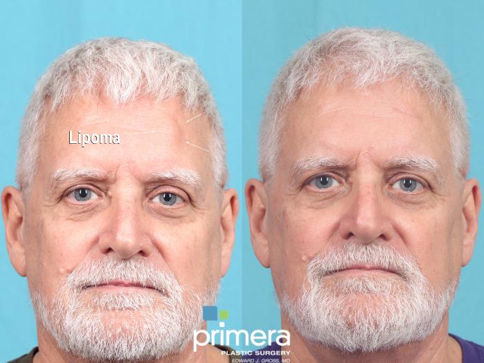 Before & After Facial Scarring Case 893 Front View in Orlando, Florida