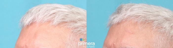 Before & After Facial Scarring Case 893 Left Oblique View in Orlando, Florida