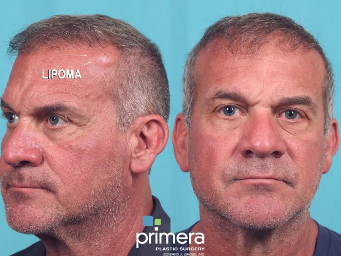 Before & After Facial Scarring Case 895 Front View in Orlando, Florida