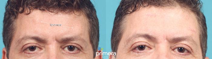 Before & After Facial Scarring Case 957 Front View in Orlando, Florida