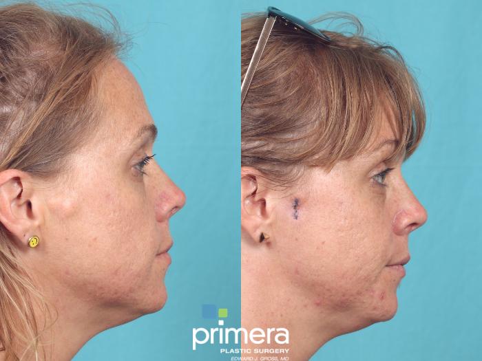 Before & After Cyst Removal Case 980 Right Side View in Orlando, Florida