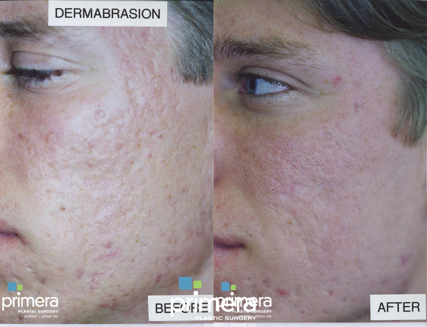 Dermabrasion deals