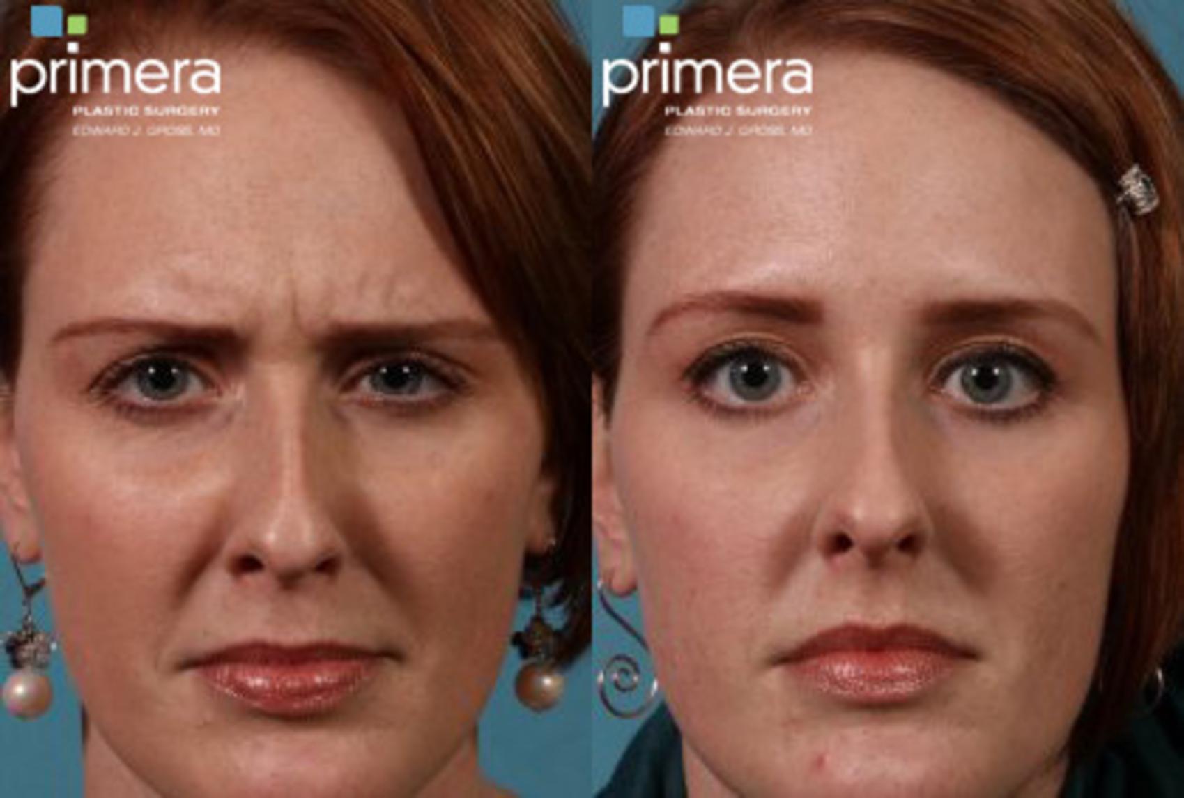 botox-results-best-in-orlando