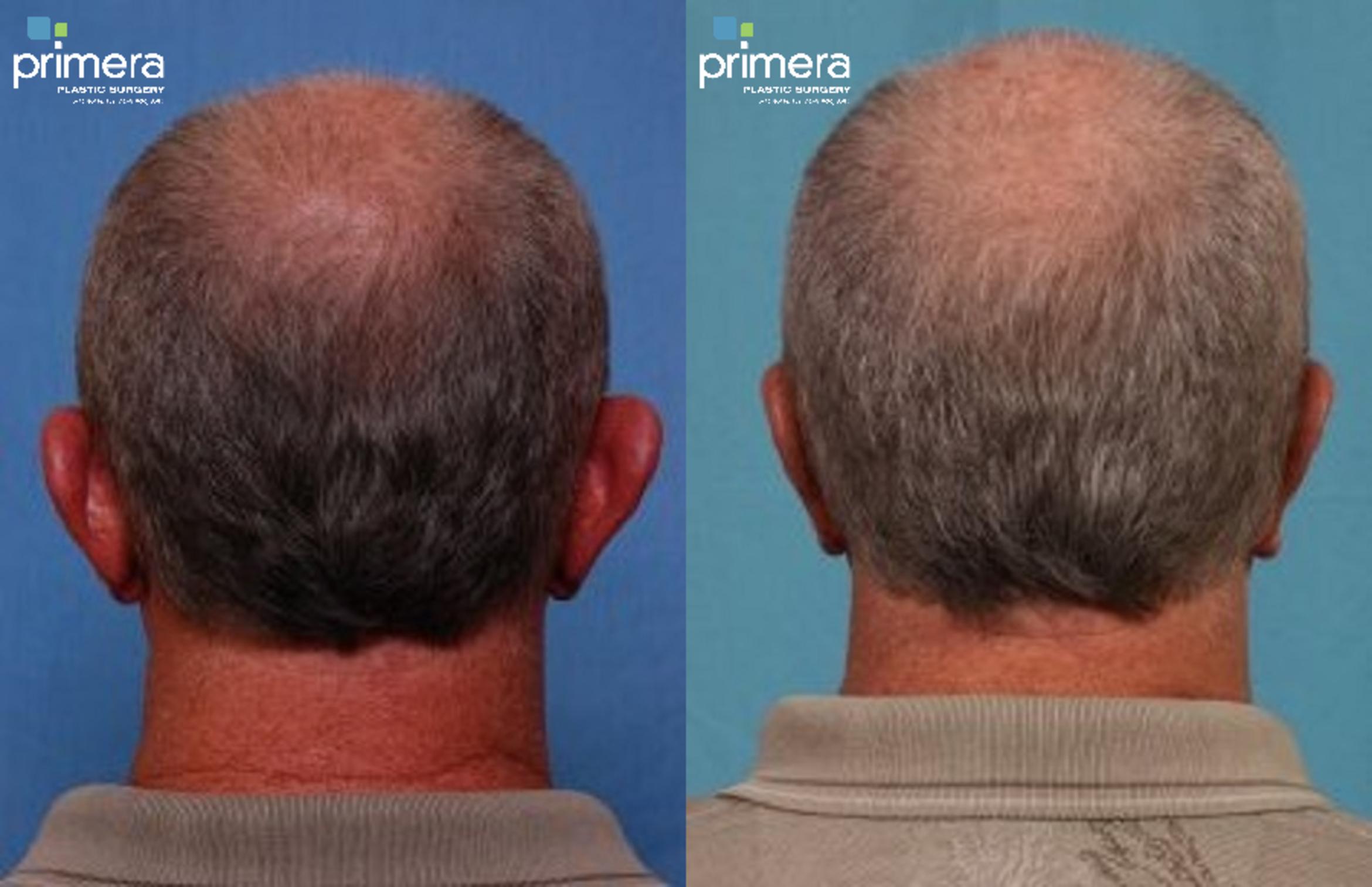 Ear Surgery (Otoplasty) Before & After Photos Patient 117 Orlando, Florida Primera Plastic Ear Surgery (Otoplasty) Before & After Photos Patient 117 Orlando, Florida Primera Plastic