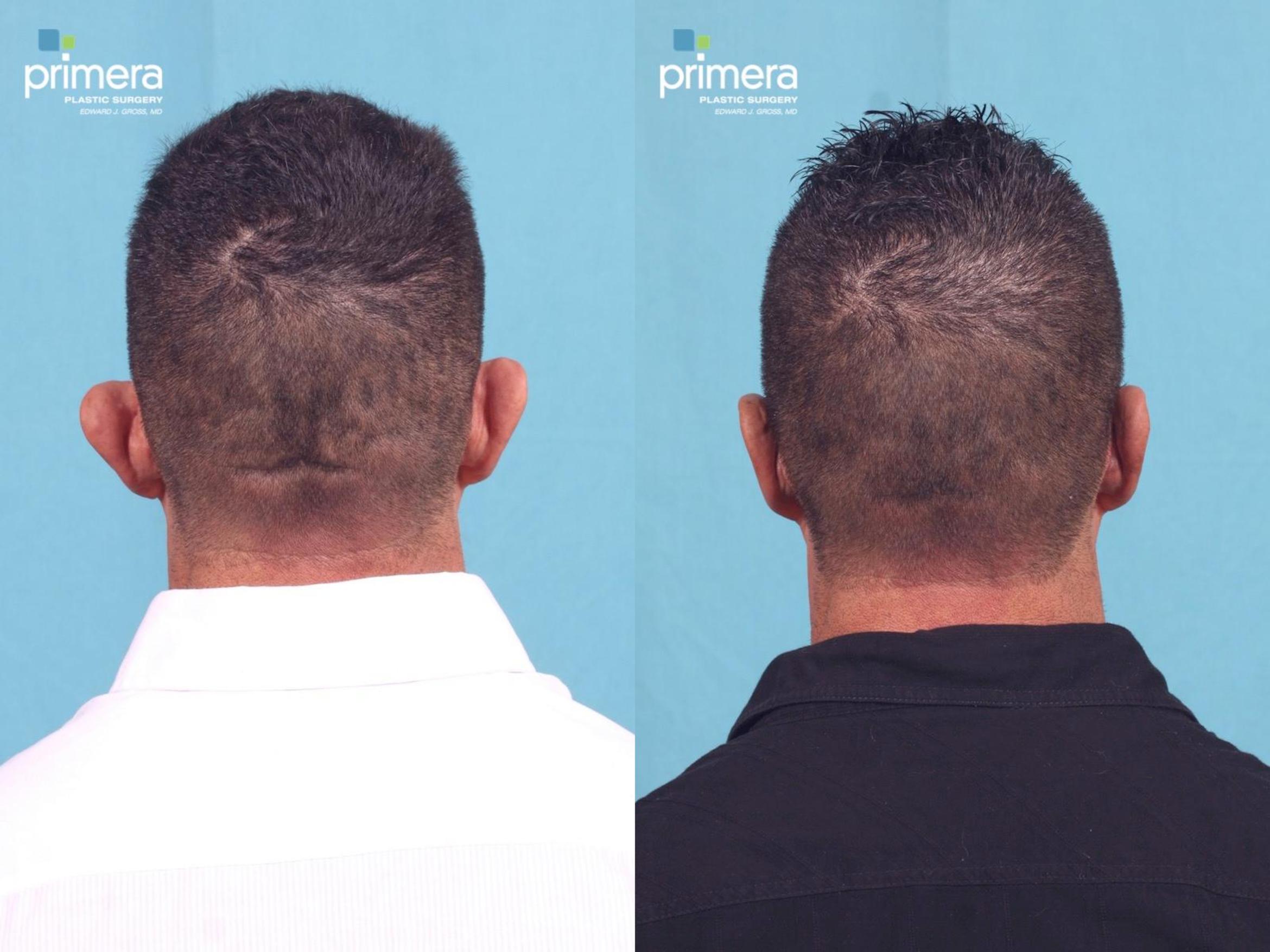 Ear Surgery (Otoplasty) Before &amp; After Photos Patient 406