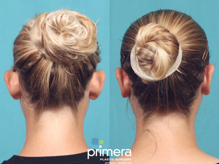 Before & After Ear Surgery (Otoplasty) Case 1018 Back View in Orlando, Winter Park & Tampa, Florida