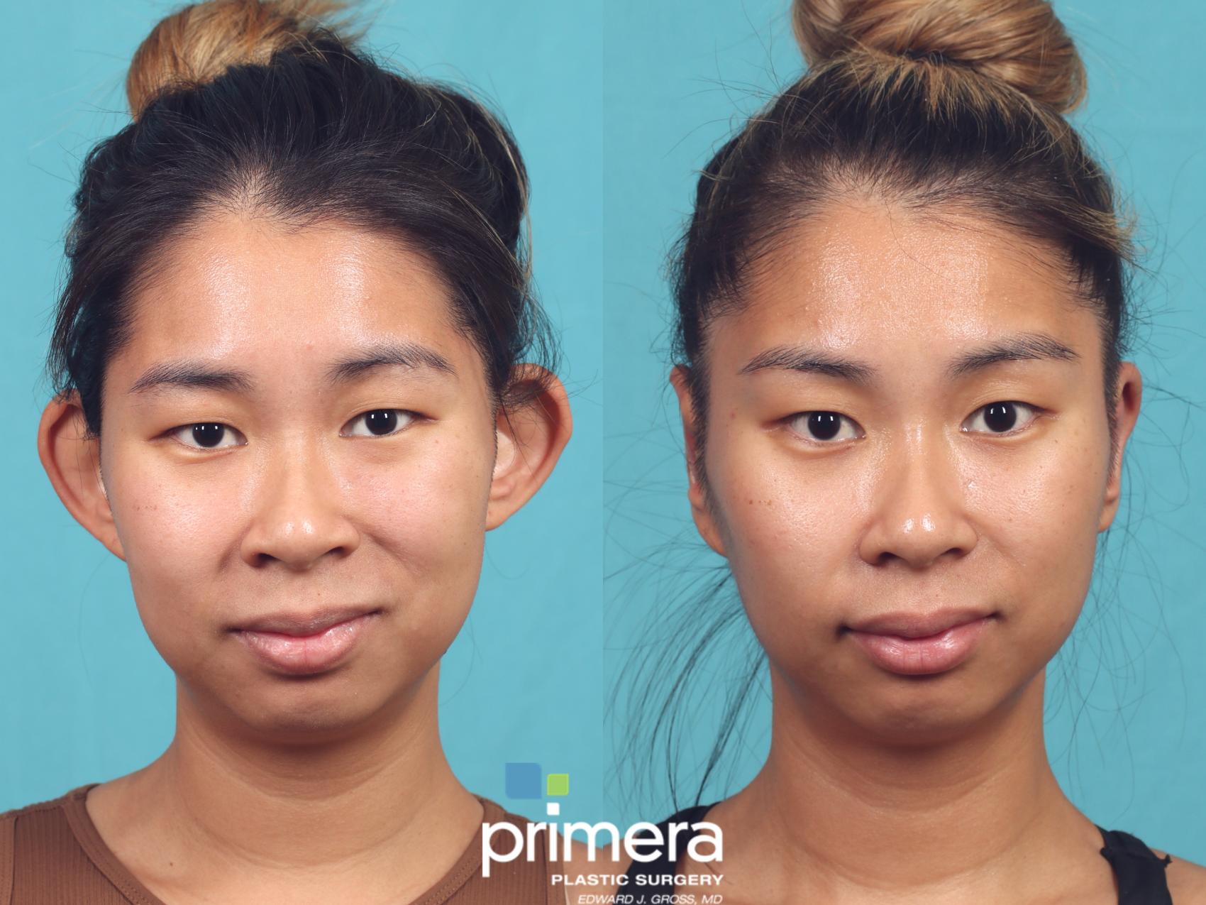 Before & After Ear Surgery (Otoplasty) Case 1022 Front View in Orlando, Winter Park & Tampa, Florida