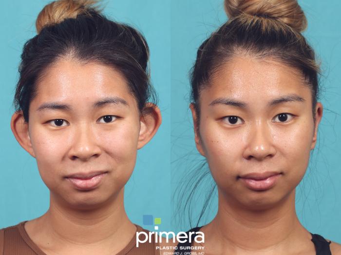 Before & After Ear Surgery (Otoplasty) Case 1022 Front View in Orlando, Winter Park & Tampa, Florida