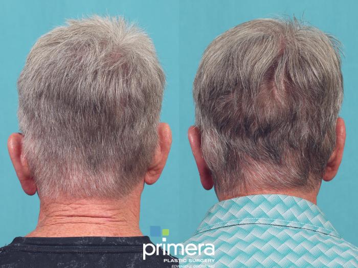 Before & After Ear Surgery (Otoplasty) Case 1025 Back View in Orlando, Winter Park & Tampa, Florida
