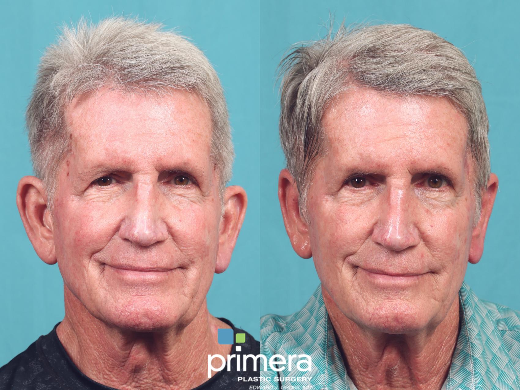 Before & After Ear Surgery (Otoplasty) Case 1025 Front View in Orlando, Winter Park & Tampa, Florida