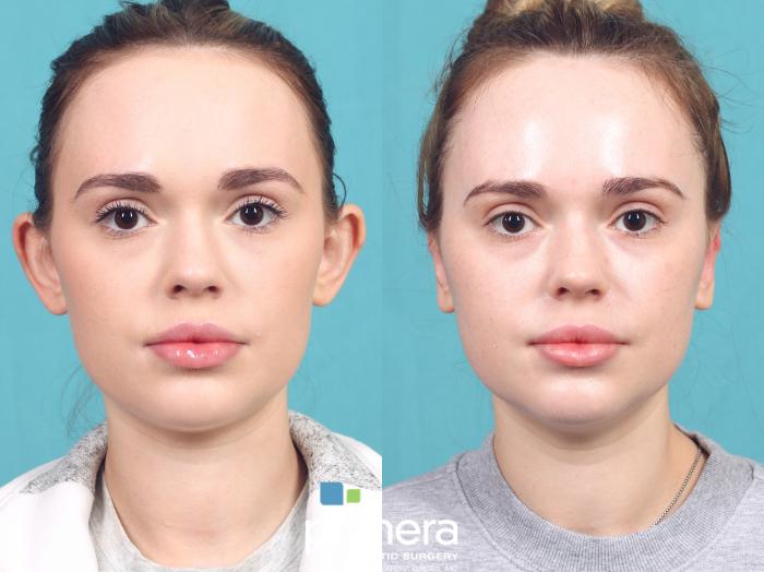 Before & After Ear Surgery (Otoplasty) Case 1029 Left Side View in Orlando, Winter Park & Tampa, Florida