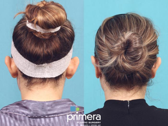 Before & After Ear Surgery (Otoplasty) Case 1056 Back View in Orlando, Winter Park & Tampa, Florida