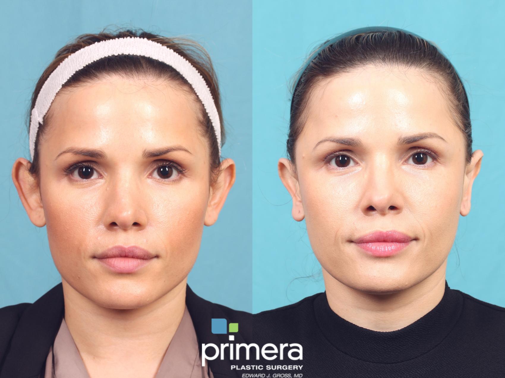 Before & After Ear Surgery (Otoplasty) Case 1056 Front View in Orlando, Winter Park & Tampa, Florida
