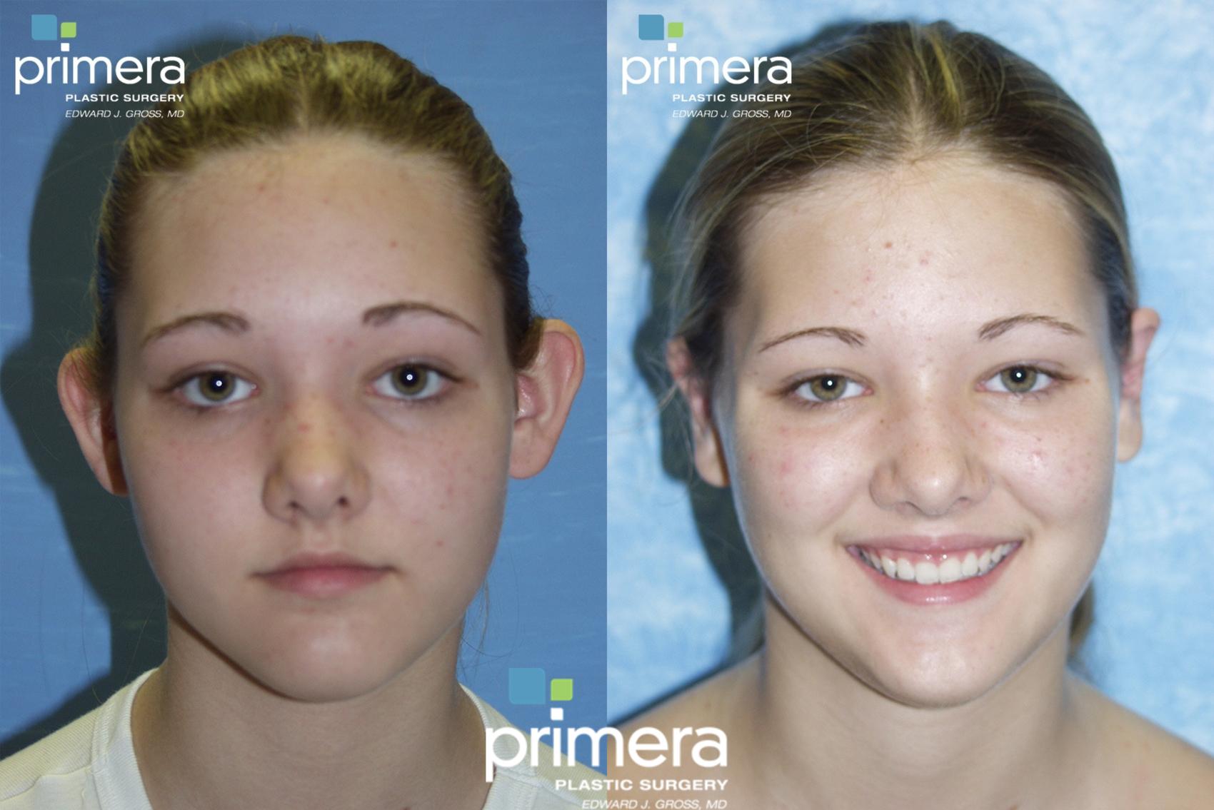 Before & After Ear Surgery (Otoplasty) Case 112 view-1 View in Orlando, Florida