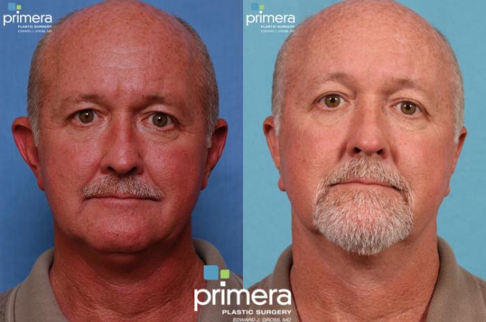 Before & After Surgery for Men Case 117 view-1 View in Orlando, Florida