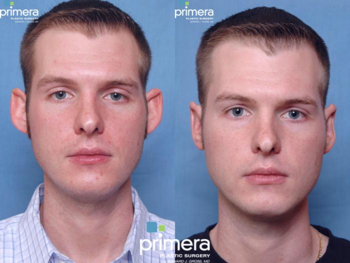 Before & After Surgery for Men Case 250 view-1 View in Orlando, Florida
