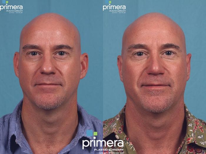 Before & After Surgery for Men Case 298 view-1 View in Orlando, Florida