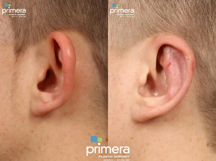 Before & After Ear Surgery (Otoplasty) Case 299 view-2 View in Orlando, Florida