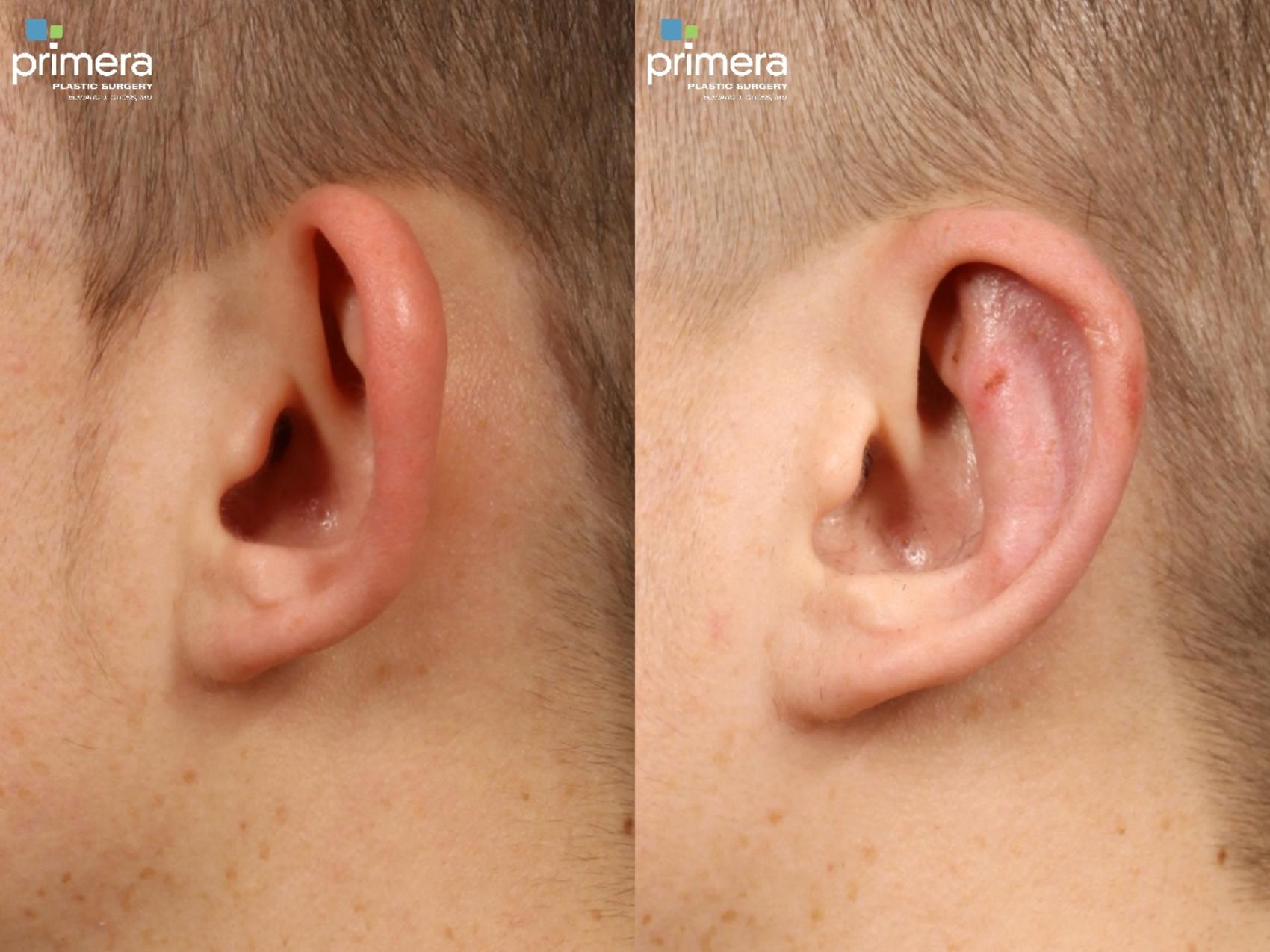 Before & After Ear Surgery (Otoplasty) Case 300 view-1 View in Orlando, Florida