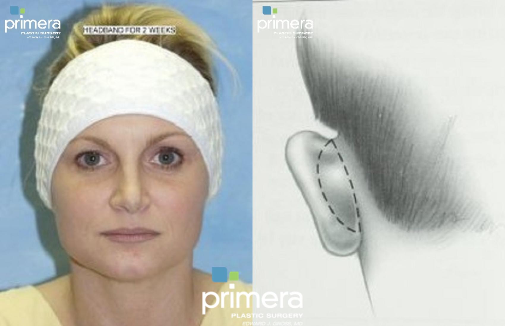 Before & After Ear Surgery (Otoplasty) Case 319 view-1 View in Orlando, Florida