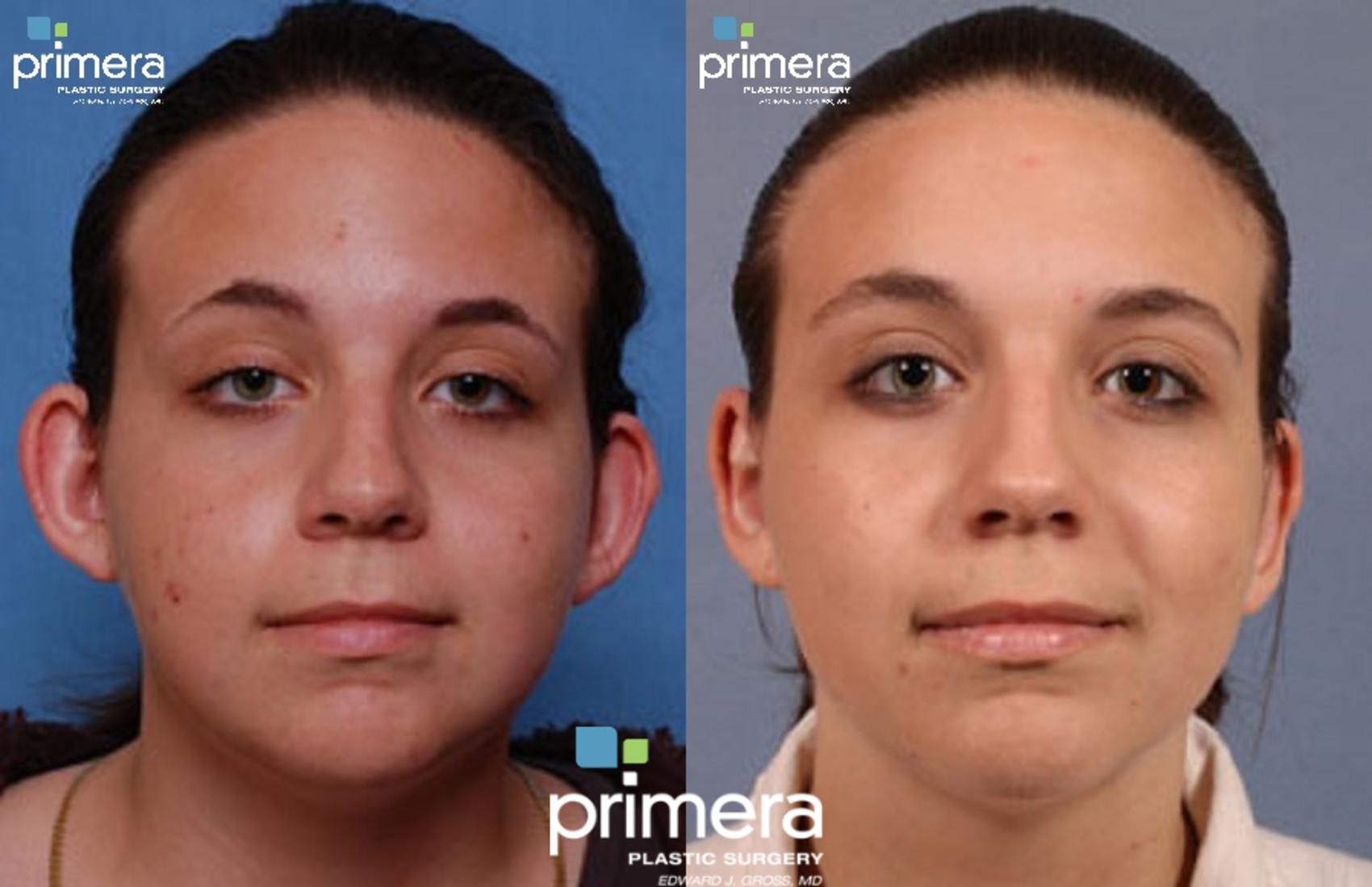Before & After Ear Surgery (Otoplasty) Case 320 view-1 View in Orlando, Florida