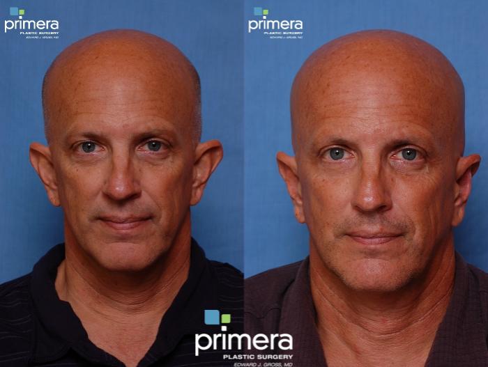 Before & After Ear Surgery (Otoplasty) Case 321 view-1 View in Orlando, Florida