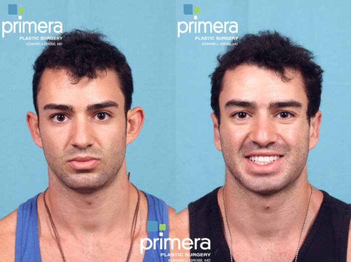 Before & After Surgery for Men Case 359 view-1 View in Orlando, Florida
