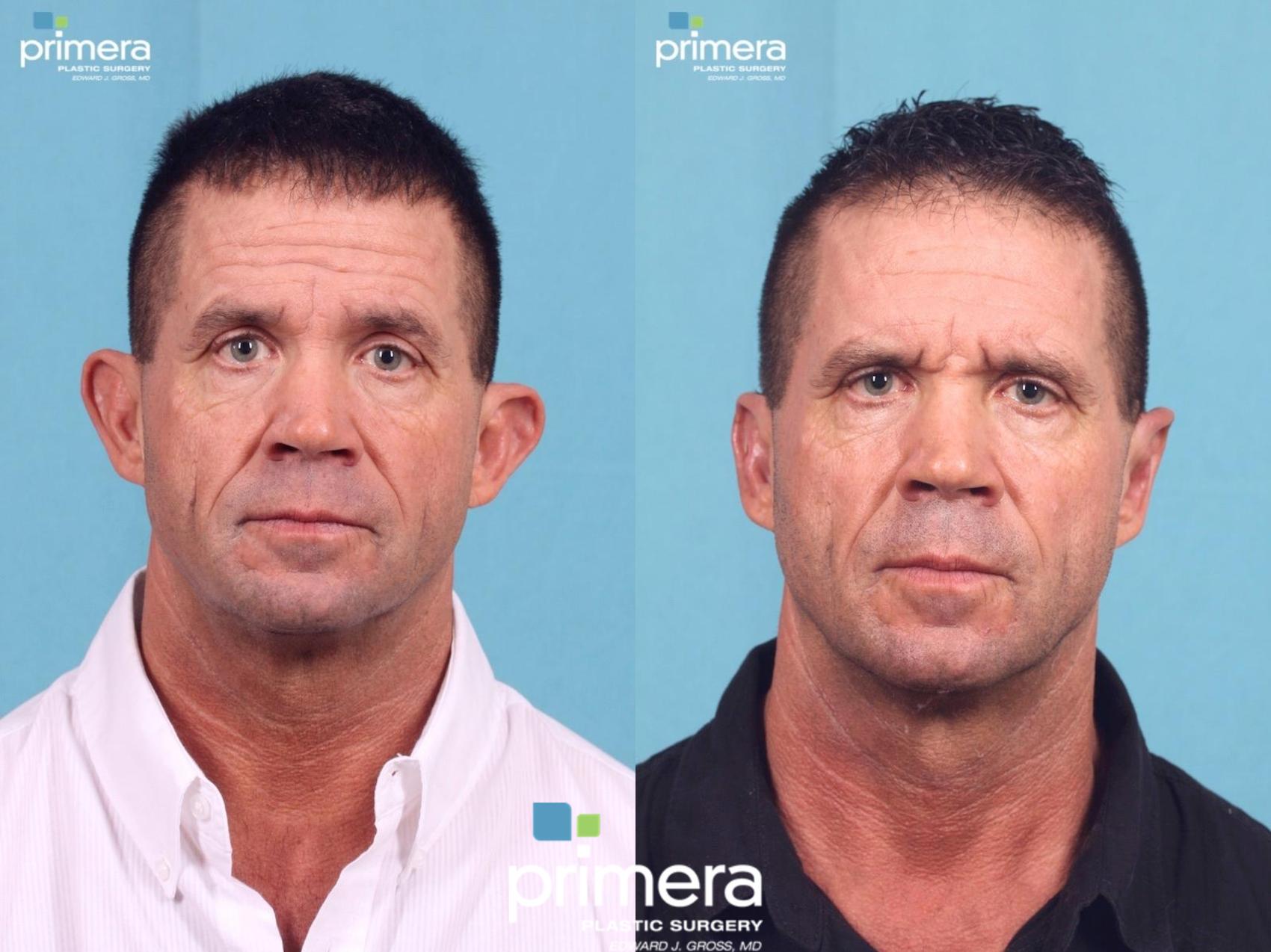 Before & After Surgery for Men Case 406 view-1 View in Orlando, Florida