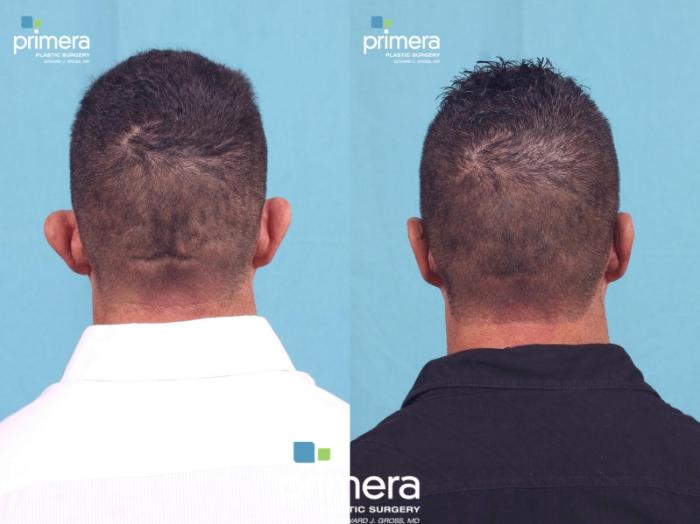 Before & After Surgery for Men Case 406 view-2 View in Orlando, Florida