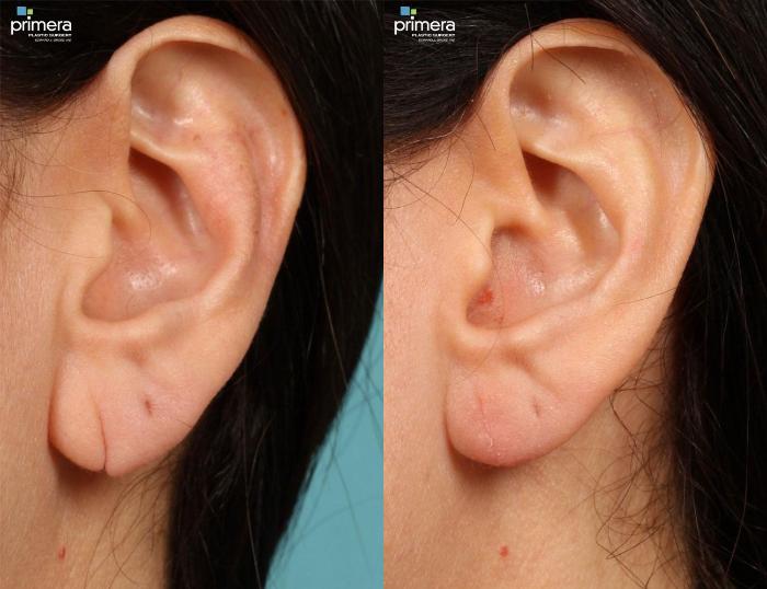 Ear Surgery Otoplasty Before And After Pictures Case 424 Orlando