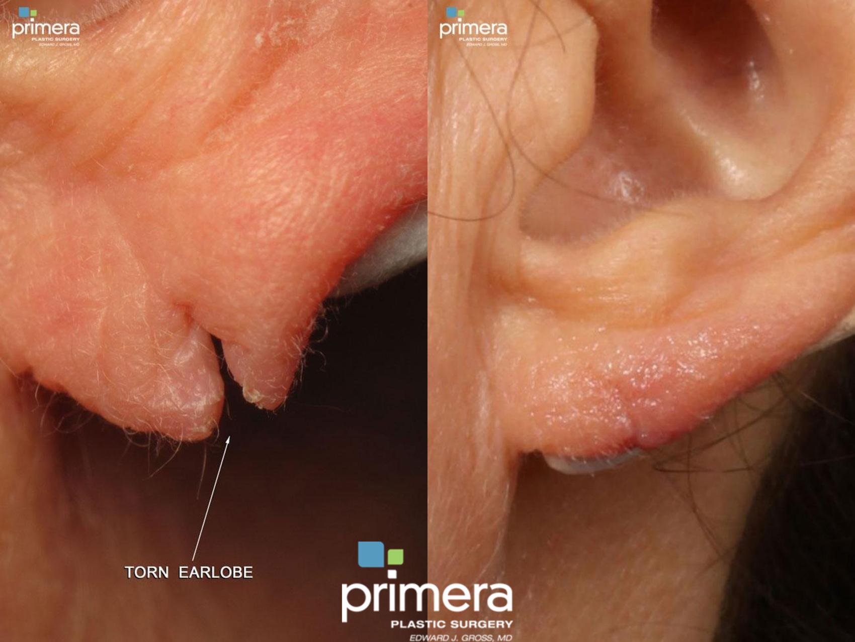 Before & After Ear Surgery (Otoplasty) Case 427 view-1 View in Orlando, Florida