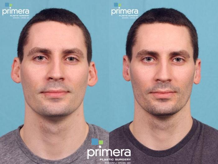 Before & After Surgery for Men Case 467 view-1 View in Orlando, Florida