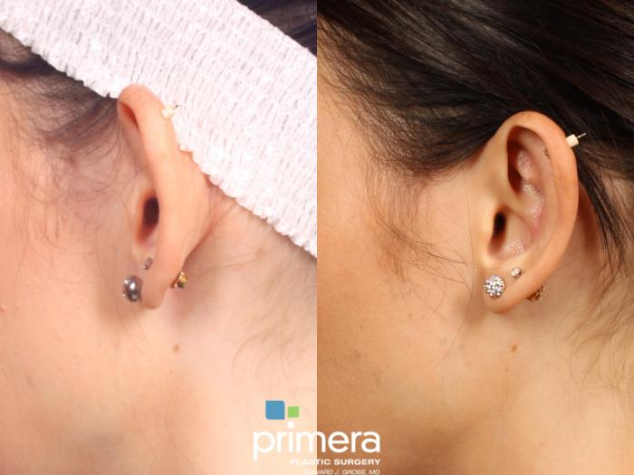 Before & After Ear Surgery (Otoplasty) Case 517 view-3 View in Orlando, Florida