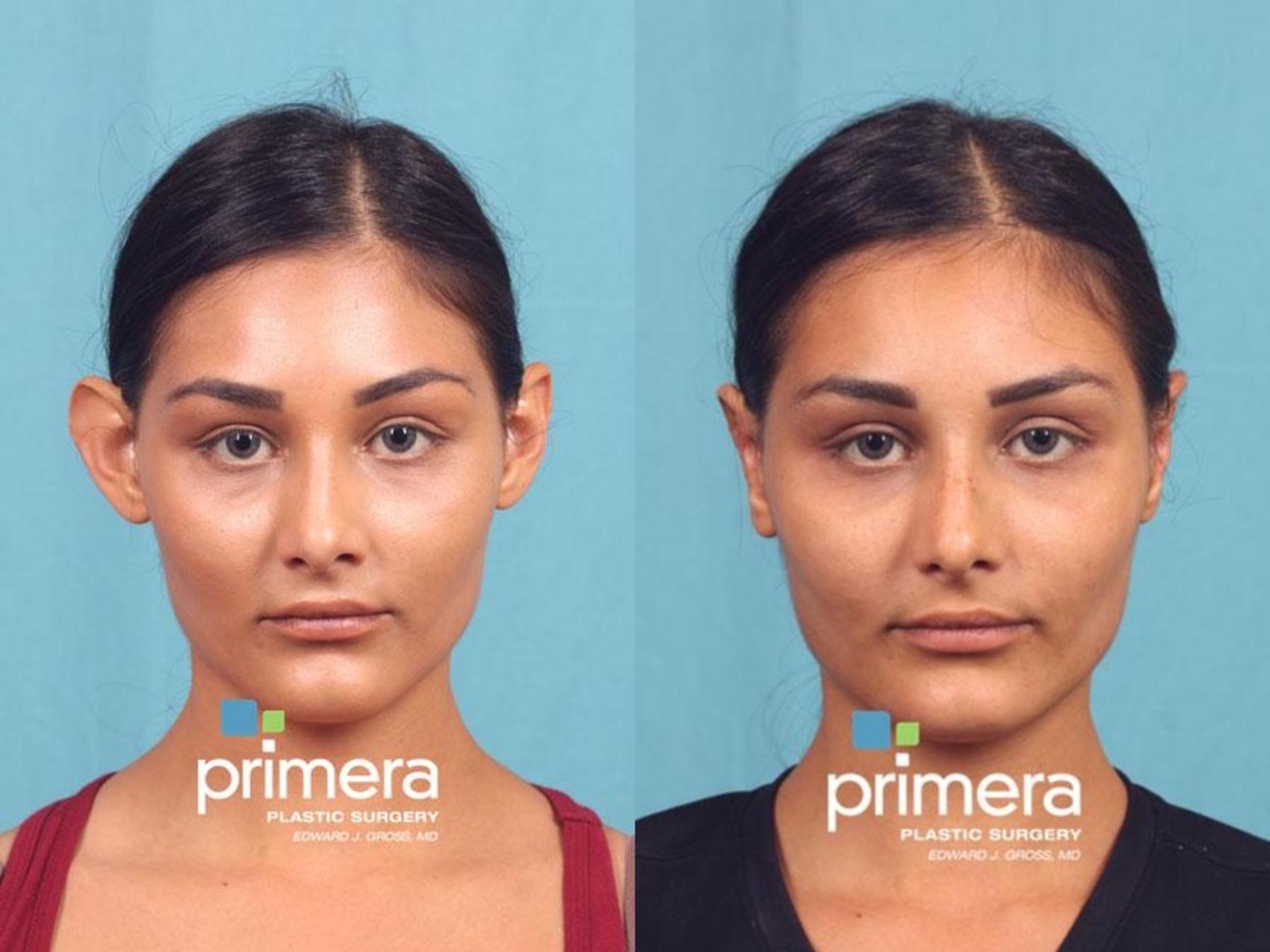 Before & After Ear Surgery (Otoplasty) Case 545 view-1 View in Orlando, Florida