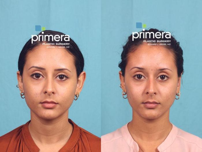 Before & After Ear Surgery (Otoplasty) Case 582 view-1 View in Orlando, Florida