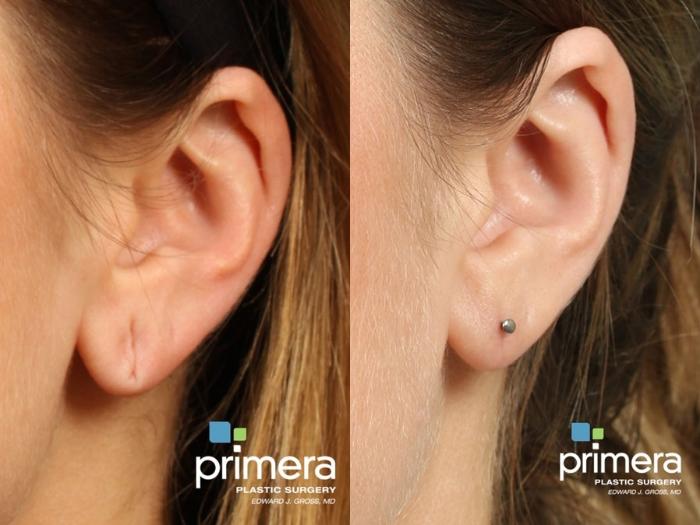 Before & After Ear Surgery (Otoplasty) Case 589 Left Oblique View in Orlando, Florida