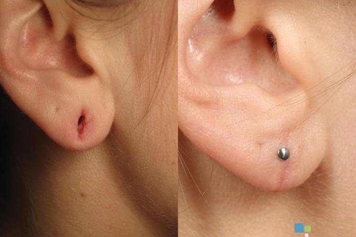 Before & After Ear Surgery (Otoplasty) Case 589 Right Side View in Orlando, Florida