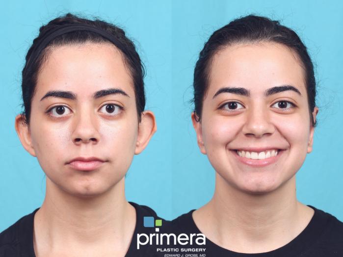 Before & After Ear Surgery (Otoplasty) Case 600 Front View in Orlando, Florida
