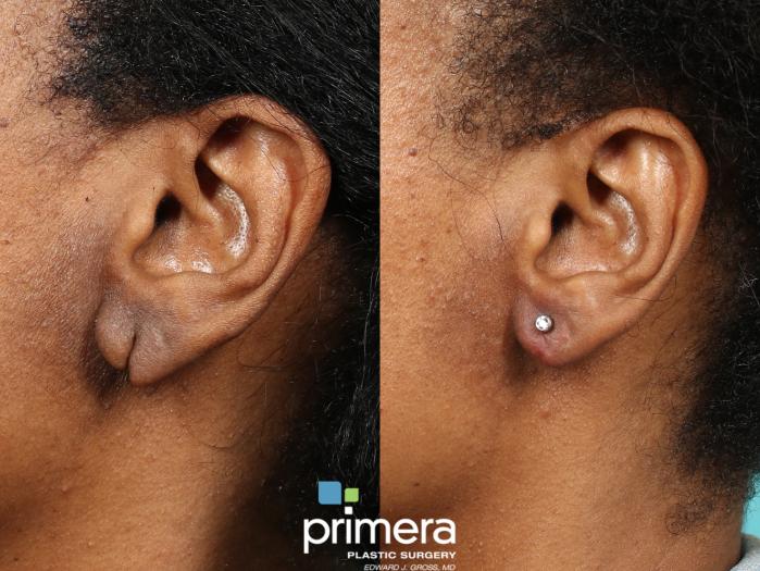 Before & After Ear Surgery (Otoplasty) Case 604 Left Side View in Orlando, Florida