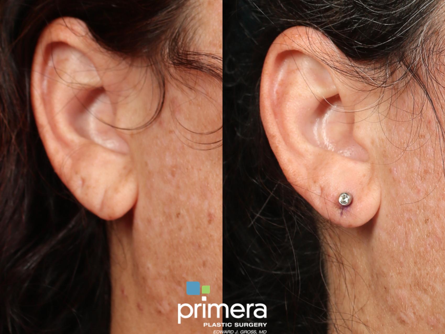 Before & After Ear Surgery (Otoplasty) Case 625 Right Side View in Orlando, Florida